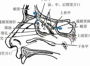 鼻旁窦发育不良