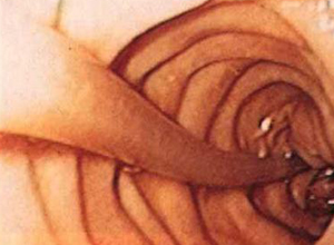 肠道蛔虫感染