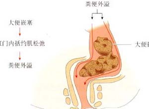 大小便潴留