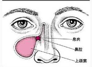 单侧鼻腔阻塞