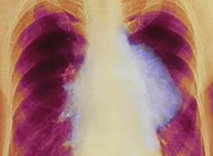肺癌胸水