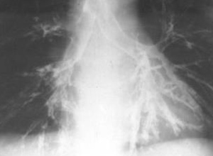 肺部或支气管周围可呈现纹理增粗及浸润现象