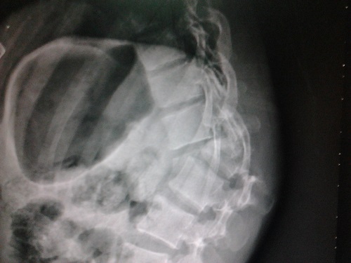 29岁妈妈刚出月子就腰椎骨折 孕期补钙3大误区