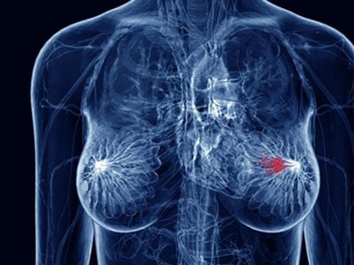 乳腺癌常见两大典型症状 了解治疗乳腺癌中医小偏方