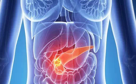研究发现胰腺癌新克星