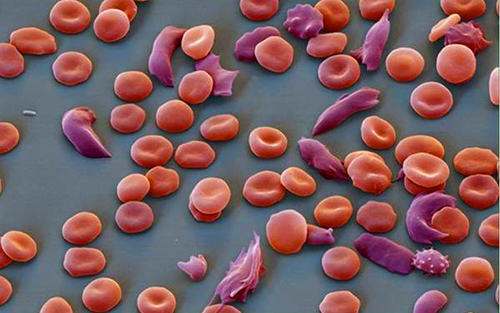 基因疗法可有效治疗镰刀型红细胞贫血症