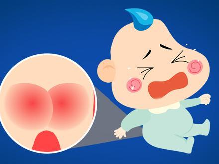 这些因素可导致宝宝红屁股 中医教你护理四方法