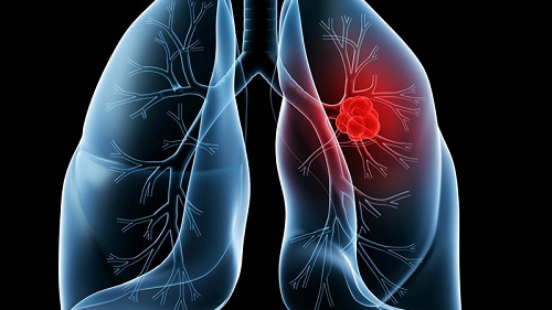 煮妇也要定期筛查肺癌 肺癌的病因有哪些_拓诊卫生资讯