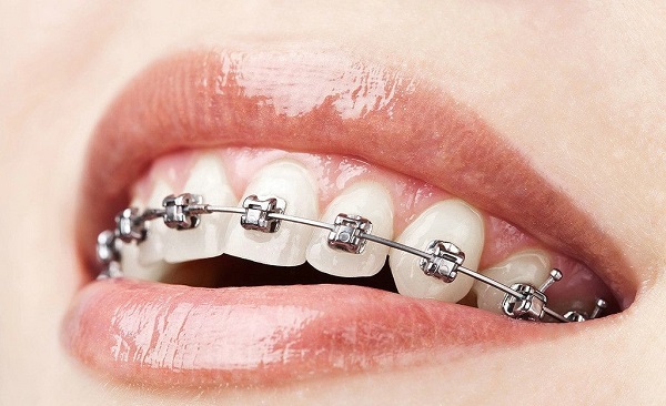 三类人要做牙齿矫正 牙齿矫正有6个步骤