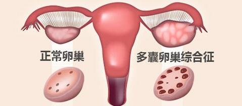 治多囊卵巢综合征可“针药联合”_拓诊卫生资讯