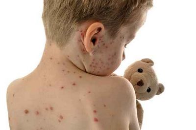 水痘初期症状类似感冒  成人得水痘会更严重_拓诊卫生资讯
