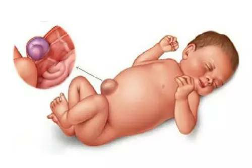 新生儿肚脐突出是为什么 肚脐突出怎么办