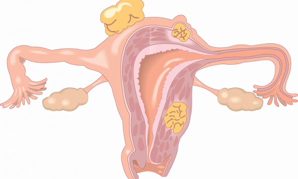 研究发现来自脂肪组织的脂联素可对抗多囊卵巢综合征