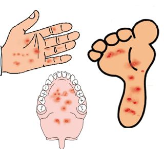 手足口病症状似感冒 手足口病护理要点有哪些