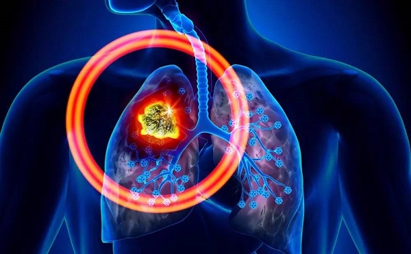 早期肺癌迎来微创治疗3.0时代_拓诊卫生资讯