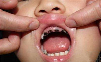 1岁男童12颗乳牙全部坏的只剩牙根，医生怒斥这坏习惯_拓诊卫生资